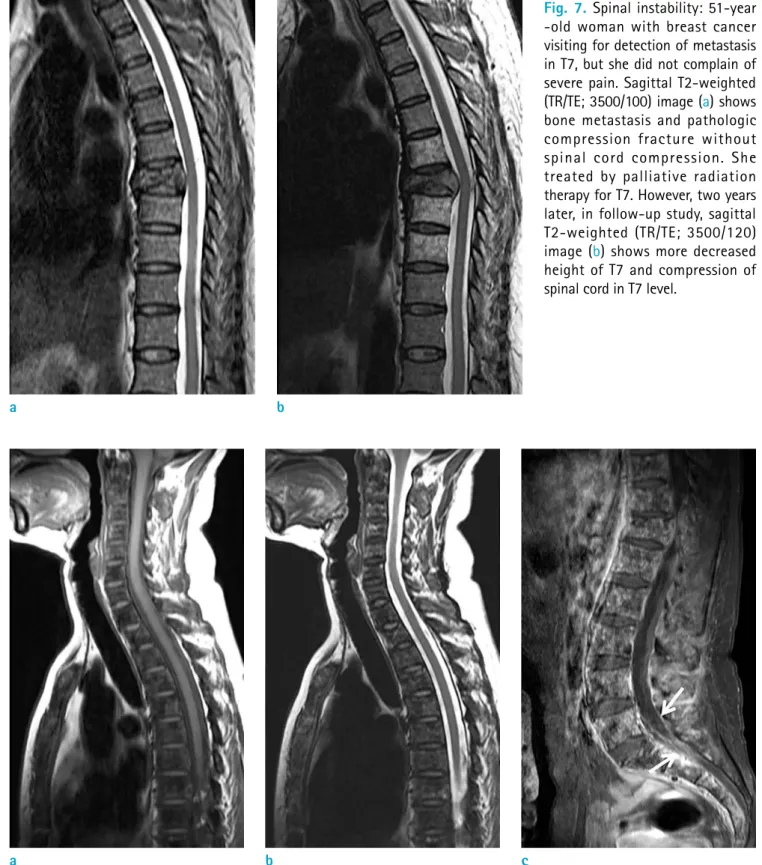 Fig. 7. Spinal instability: 51-year  -old woman with breast cancer  visiting for detection of metastasis  in T7, but she did not complain of  severe pain