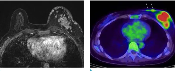 Fig. 5. A 62-year-old woman with mixed invasive ductal and mucinous cancer involving left breast underwent breast MRI  and PET-CT
