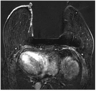 Fig. 7.  A 70-year-old woman with invasive lobular cancer  involving right breast underwent breast MRI