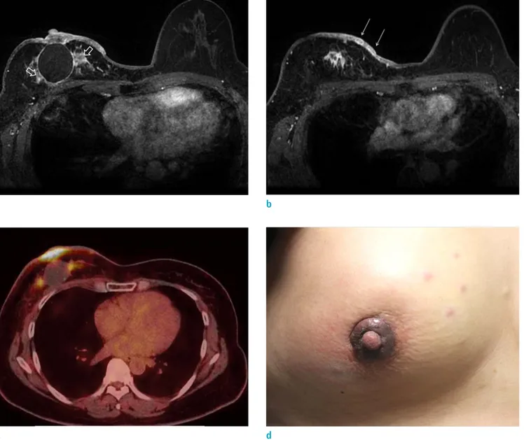 Fig. 8. A 46-year-old woman who underwent wide excision of right breast 13 months before due to invasive ductal cancer