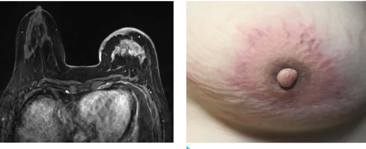 Fig. 9. A 56-year-old woman, who underwent chemotherapy due to advanced gastric cancer, complained of swelling and  erythema of left breast