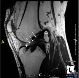 Fig. 1. Intraarticular curvature on reformatted MRI. 