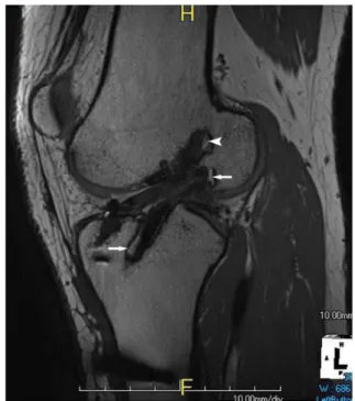 Fig. 3. 3D proton density-weighted image (PDWI) was  taken in a 21-year-old man 12 months after double-bundle  reconstruction