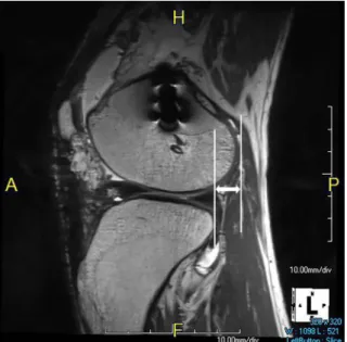 Fig. 5. 3D proton density-weighted image (PDWI) was  taken in a 43-year-old man 19 months after double-bundle  reconstruction