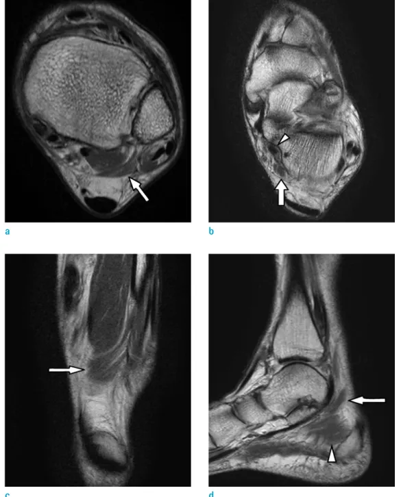 Fig. 1. MR images of the left ankle. (a) Axial proton density-weighted image (TR/TE, 3000/44) shows the flexor digitorum  accessorius longus (FDAL) muscle (arrow) originating from the posterior muscular compartment