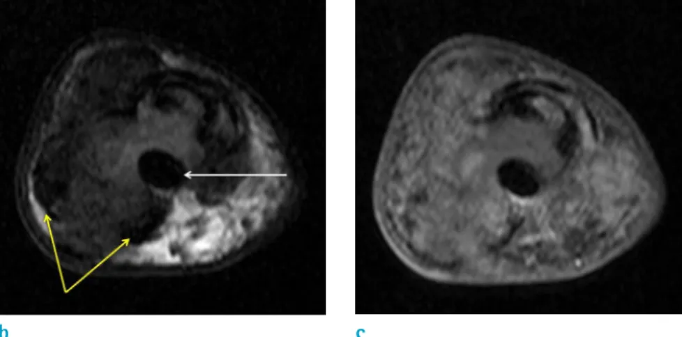 Fig. 3. Bone scan shows mild  uptake (arrow) in the proximal  phalanx of the right fifth finger.
