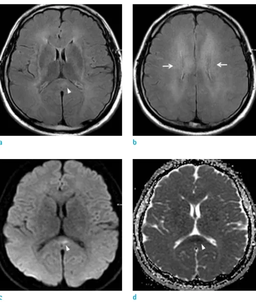 Fig. 1.  On fluid-attenuated  inversion recovery (FLAIR) images of  follow-up brain MRI 4 weeks after  CO intoxication (a, b), ill-defined  high signal intensity lesions are  seen along the both periventricular  white matters, centrum semiovale  (white arr