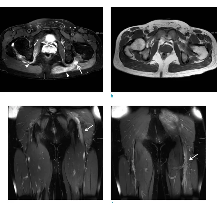 Fig. 2. On lower extremity MRI, axial fat-suppressed T2-weighted image (a) and T1-weighted image (b) show swollen left  sciatic nerve with T2 hyperintensity (arrow)