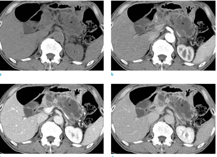 Fig. 1.  Unenhanced (a), arterial (b), portal (c), and delayed (d) phases of the dynamic computed tomography (CT) image  of the pancreas