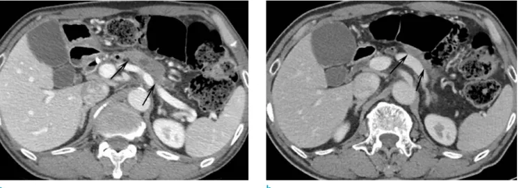 Fig. 3.  Microscopic examiantion shows that foamy  macrophages (thick arrows) are intermingled with  inflammatory cells, and interspersed with multinucleate  giant cell (thin arrow), displaying the characteristic  appearances of xanthogranulomatous inflamm