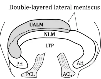 Fig. 1. A schematic illustration of the double layered  lateral meniscus, which is characteristic that the upper  additional meniscus overlays the normal lateral meniscus