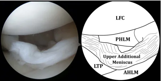 Fig. 3. Arthroscopic view of the lateral compartment shows that the upper additional meniscus overlying the normal  lateral meniscus is displaced toward the intercondylar notch and mimics the bucket-handle tear; while the shape, margin  and volume of the l