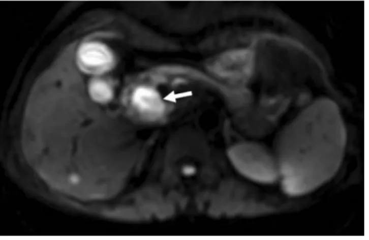 Fig. 3. The surgical specimen shows a mural defect in the  CBD (arrow).