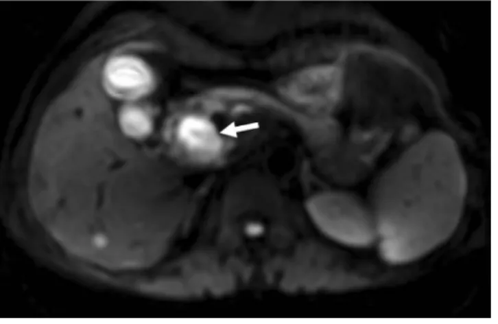 Fig. 3. The surgical specimen shows a mural defect in the  CBD (arrow).