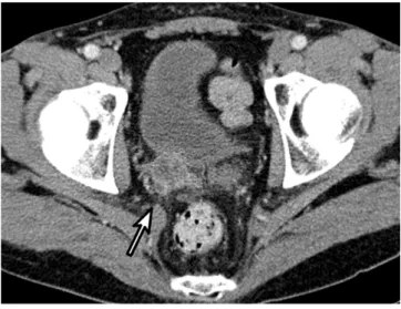 Fig. 1. Primary diffuse large B-cell lymphoma in the seminal  vesicle in a 58-year-old man
