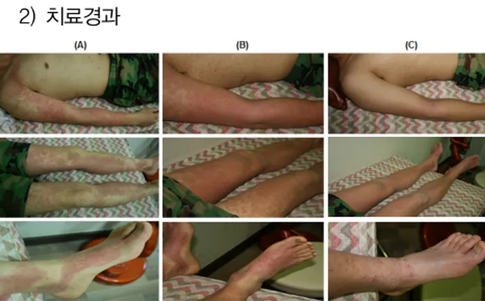 Fig.  1.  Treatment  for  atopic  dermatitis.  Each  picture  was  photographed  at  15  June,  2007  (A),  27  June,  2007  (B)  and  24  July,  2007  (C),  respectively