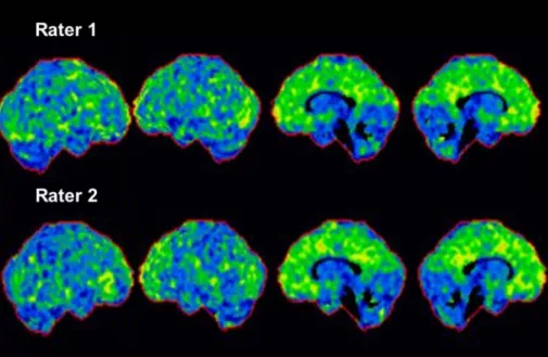 Fig. 3. Cortical thickness map (a)  and Z-score map (b) using CorThick  analysis software, with comparison  between rater 1 and rater 2