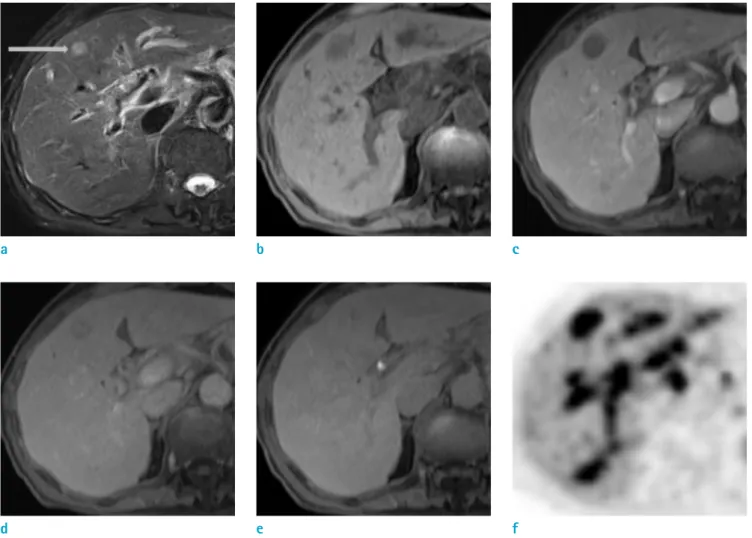 Fig. 1. An 80-year-old man with secondary hepatic lymphoma. (a) On T2-weighted imaging, there was a high signal  intensity nodule (arrow) in S4 of the liver