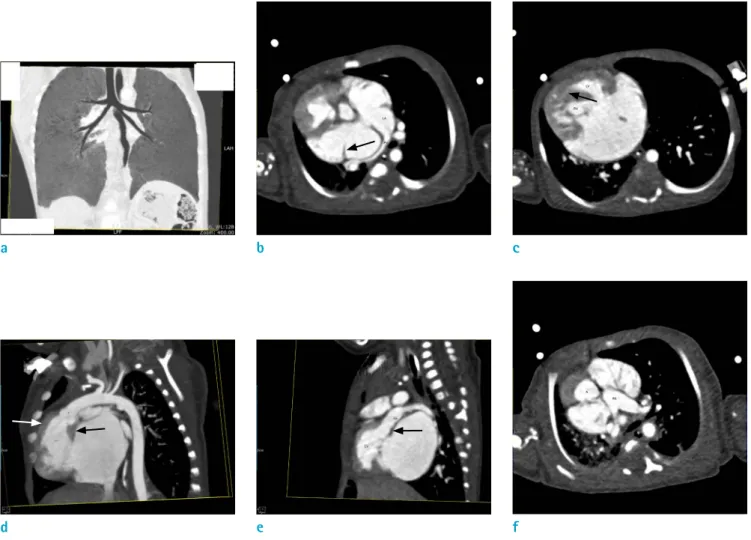 Fig. 5. (a) Baby with atrioventricular septal defects, CT with coronal reformat and lung window setting showing the  branching of left and right main bronchi into upper lobe bronchus and bronchus intermedias, indicating bilateral  morphological right bronc