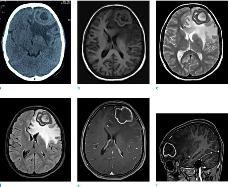 Fig. 1. (a) Non-contrast CT scan of head revealed an irregular cystic mass with concentric slightly thick wall in the left  frontal lobe with moderate perilesional edema and mass effect