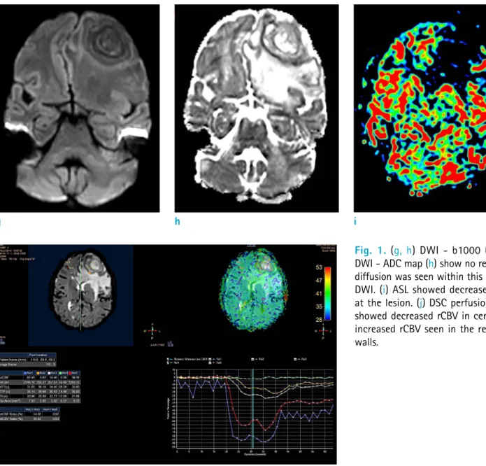 Fig. 1. (g, h) DWI - b1000 (g) and  DWI - ADC map (h) show no restricted  diffusion was seen within this mass in  DWI