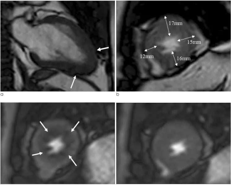 Fig. 1. A 45-year-old male with angina pain who visited to emergency room was confirmed as apical HCM by typical ECG and echocardiographic findings, and he performed CMR for risk stratification.