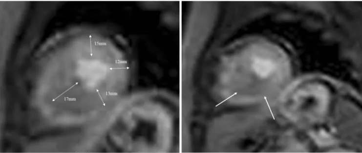 Fig. 2. A 54-year-old female with dyspnea who confirmed as apical HCM by typical ECG and echocardiographic findings.