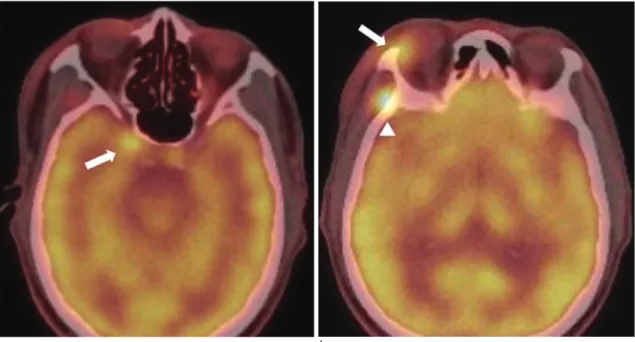 Fig. 2. Positron emission tomography scans showing multifocal intensity hypermetabolic lesions in (a) right optic canal (arrow) (b) right upper eyelid (arrow) and right sphenoid bone (arrow head).