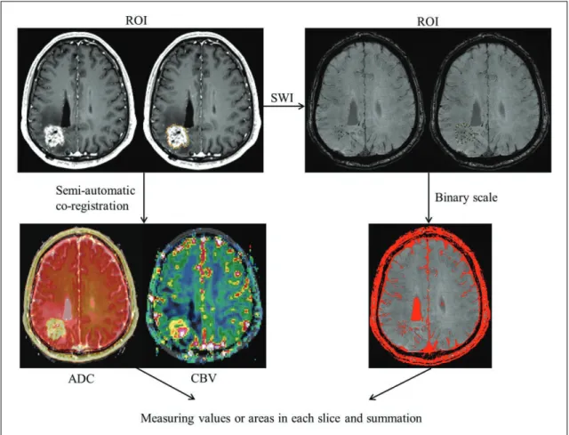 Fig. 2. Flow chart of quantitative image analysis. Region of interest (ROI) was manually selected in each section of the enhancing lesions, and was semi-automatically co-registered with the apparent diffusion coefficient and relative cerebral blood volume 