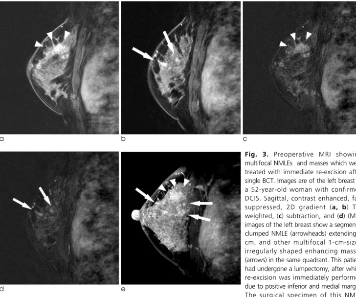 Fig. 3. Preoperative MRI showing multifocal NMLEs  and masses which were treated with immediate re-excision after single BCT