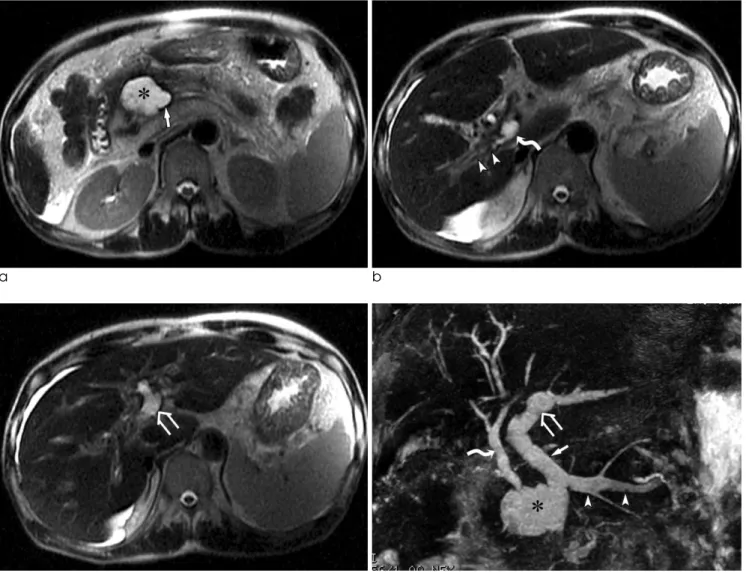 Fig. 2. a-c. Single-shot FSE T2-weighted images show a communication of the pseudocyst (asterisk) with the splenoportal confluence (arrow)