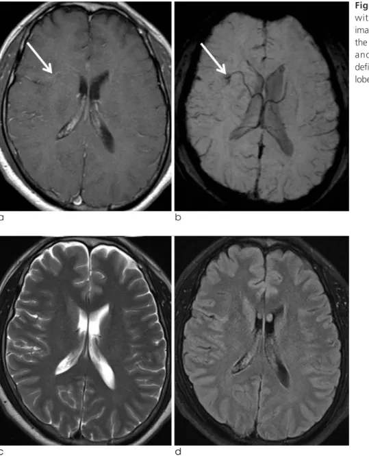 Fig. 1. A 45-years-old male patient with DVA. Enhanced T1-weighted image (a) and SWI (b) show a DVA in the right frontal lobe (arrow)