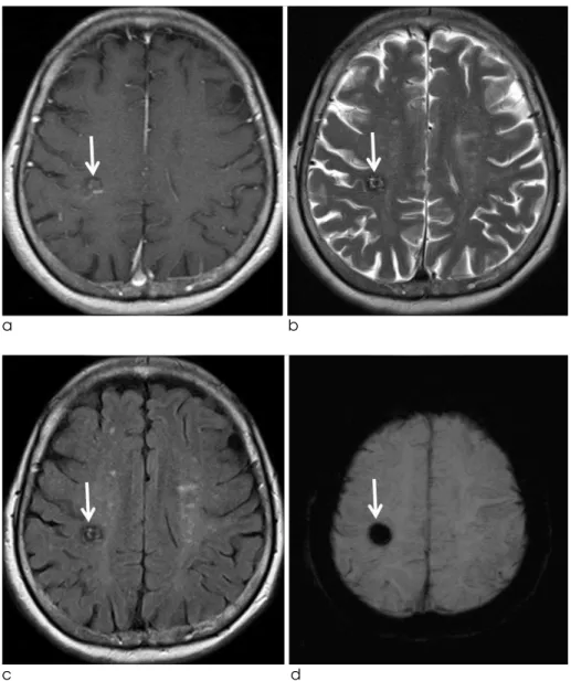 Fig. 3. A 77-years-old female patient with mixed angioma (DVA and cavernous angioma). Enhanced T1 (a), T2 (b), FLAIR (c), and SWI (d) images show a hemorrhagic lesion with heterogeneous signal intensity (suggestive of cavernous angioma) in the right pariet