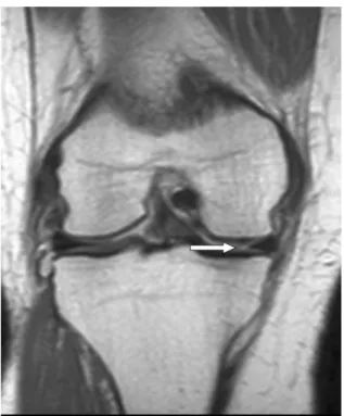 Fig. 2. Pseudoradial tear at the junction of anterior horn to body of the medial meniscus in a 39-year-old women on proton density-weighted coronal image (TR/TE, 2651/12; 4-mm section thickness) shows adjacent fluid signal intensity at the blunted tip of t