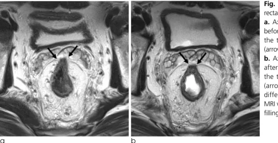Fig. 5. A 45-year-old man with lower rectal cancer and CRM involvement.