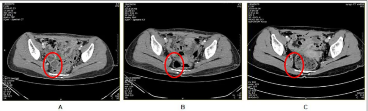 Fig. 2. Comparison of computed tomography images : taken february, may and september 2018.