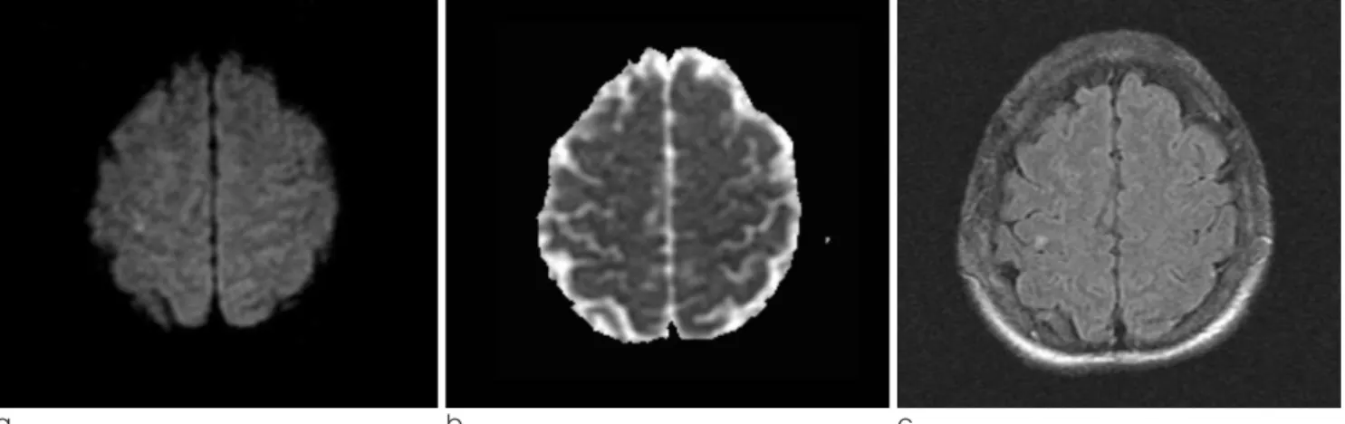Fig. 1. In case 1, a diffusion weighted (a), an apparent diffusion coefficient (b) and a T2 FLAIR (c) images showed an acute infarction on the right frontal cortex