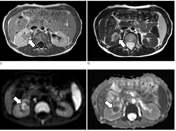 Fig. 2. On magnetic resonance images, the renal mass shows low to intermediate signal intensity on T1-weighted imaging (a) and intermediate to high signal intensity on T2-weighted imaging (b)