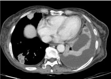 Fig. 1. Contrast-enhanced axial chest computed tomography (CT) scan showing a consolidative lesion with multiple nodules and inner necrosis in the left upper lobe (LUL) of the right lung.