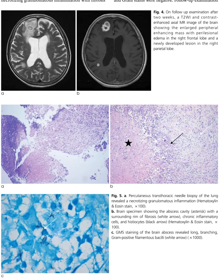 Fig. 4. On follow up examination after two weeks, a T2WI and  contrast-enhanced axial MR image of the brain showing the enlarged peripheral enhancing mass with perilesional edema in the right frontal lobe and a newly developed lesion in the right parietal 