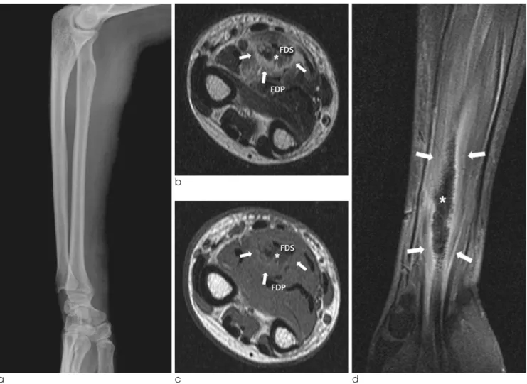 Fig. 1. A 26-year-old woman with foreign body injection in both forearms. 
