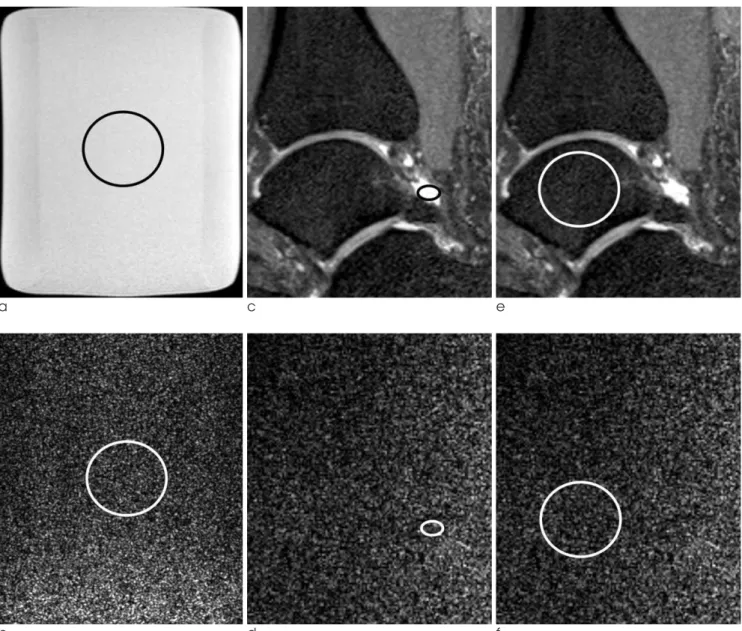 Fig. 1. Signal to noise ratio (SNR) analysis from images obtained from a phantom (a, b) and a non symptomatic volunteer (c-f) using Volume Isotropic Turbo Spin Echo Acquisition (VISTA) sequence.