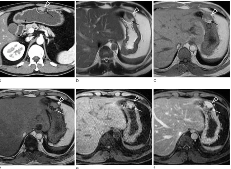 Fig. 1. 38-year-old man with ectopic pancreas in gastric lower body.