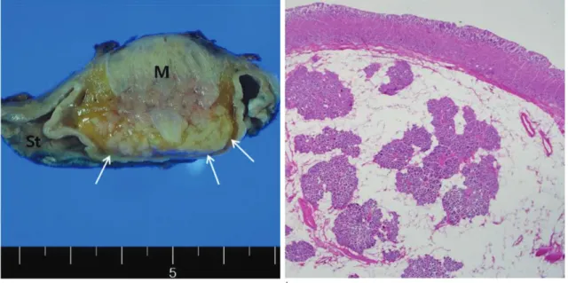 Fig. 1. g. Gross cut surface of the specimen shows a well-demarcated submucosal mass (M) surrounded by adipose tissue (arrows) and deeply burried within the muscularis propria.