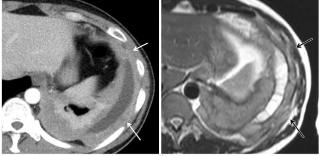 Fig. 1. Differences between clinical T stage and corrected surgical T stage in patients with available surgical stage