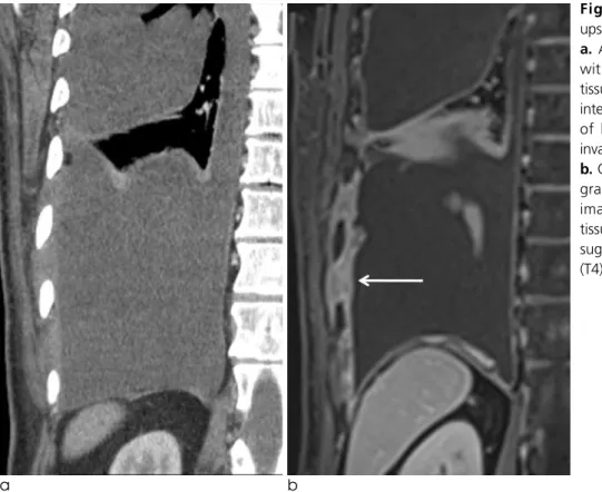 Fig. 3. Differences between clinical stage by CT only and CT and MR.