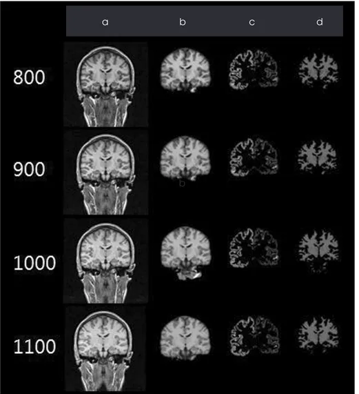 Fig. 1 The results of images from the 3D MRI using automatic segmentation software. Original image (a), brain mask image (b), that removed skull from the original image (c), white matter (d)