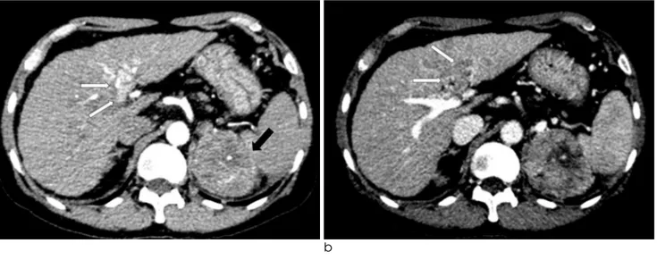 Fig. 2. Follow-up dynamic contrast enhanced CT scan obtained 4 months after the initial CT.
