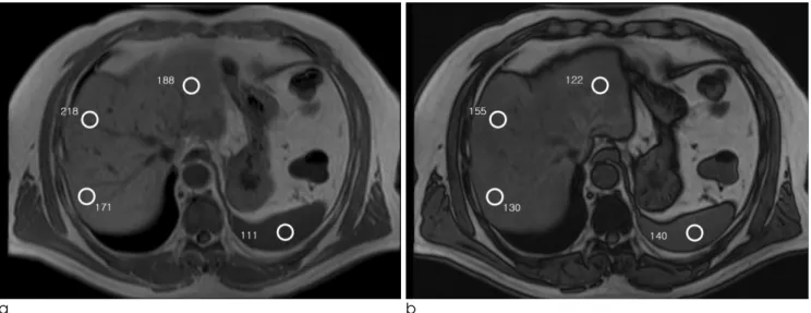 Fig. 2. Chemical shift MRI of the liver in-phase (A) and out-of-phase in a 52-year-old man.