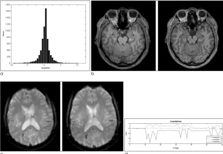 Fig. 6. (a) Error distribution between markers with fixed distance. (b) No component of the system affects result MR image quality T1 image (c) fMRI image (d) Head motion tracking of subject during fMRI image acquisition by using SPM